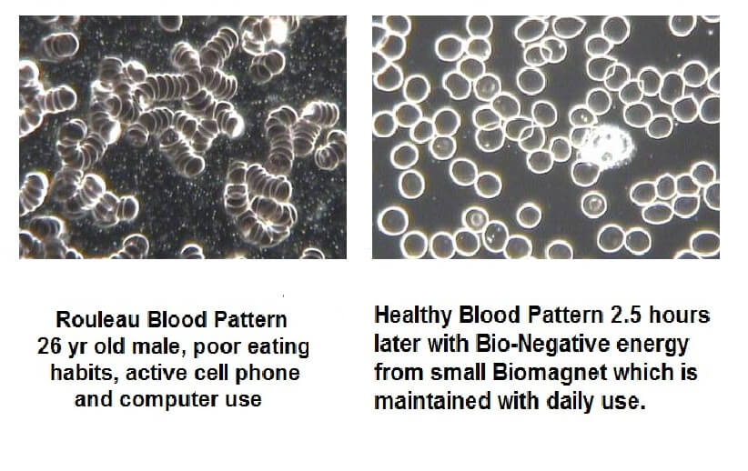 Rouleau blood pattern vs health blood pattern