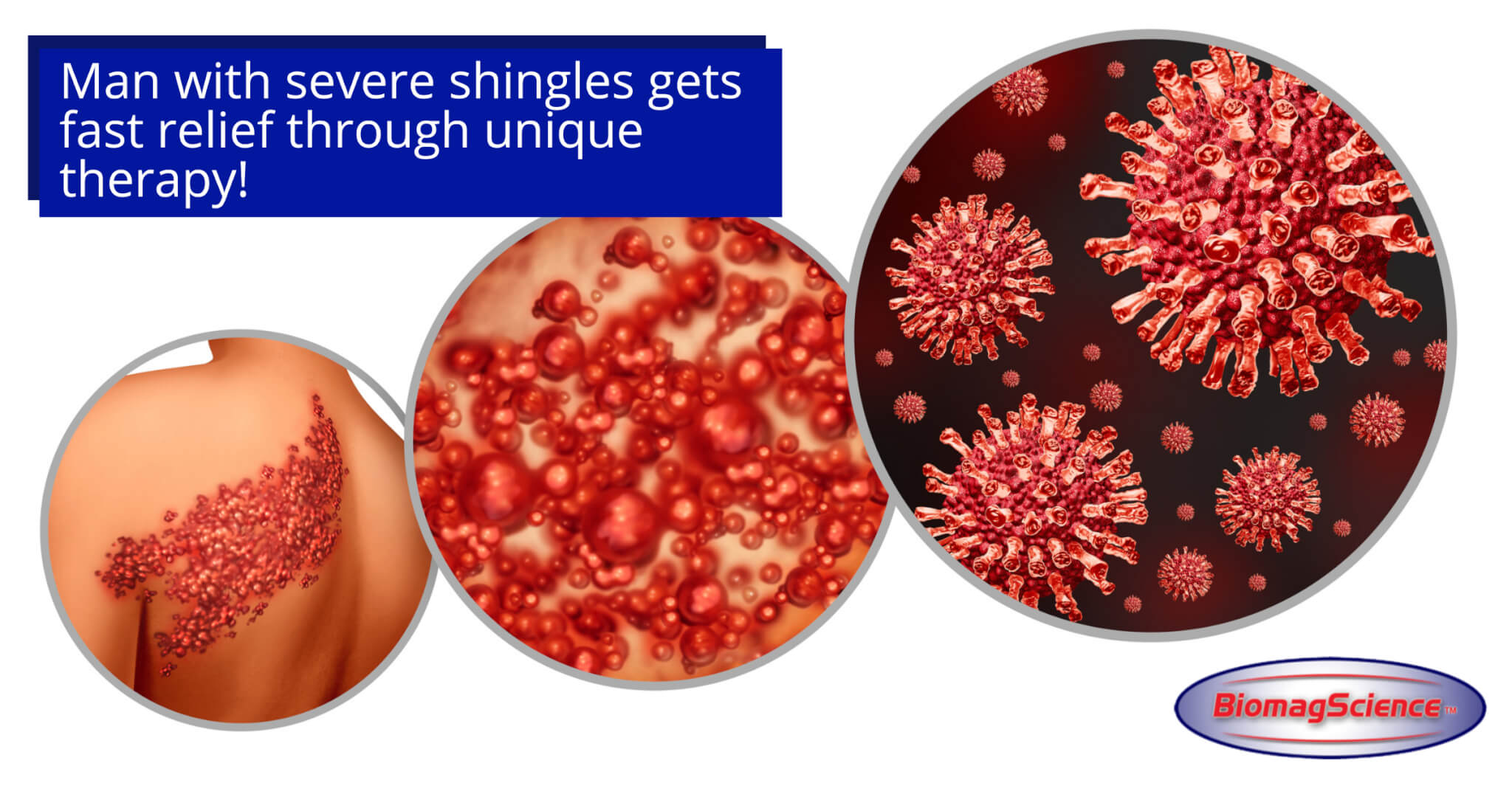 biomagscience acute shingles landscape